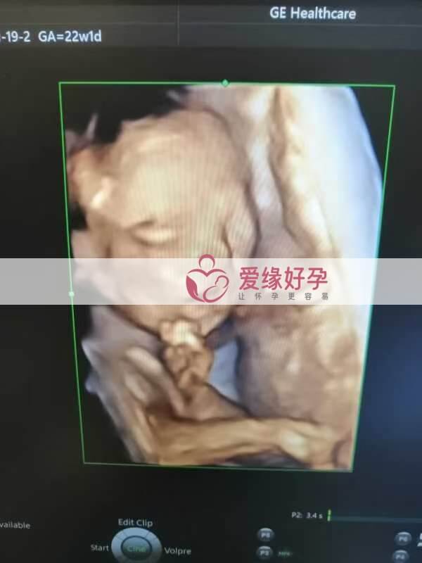 哈萨克斯坦试管婴儿助孕妈妈22周产检通过