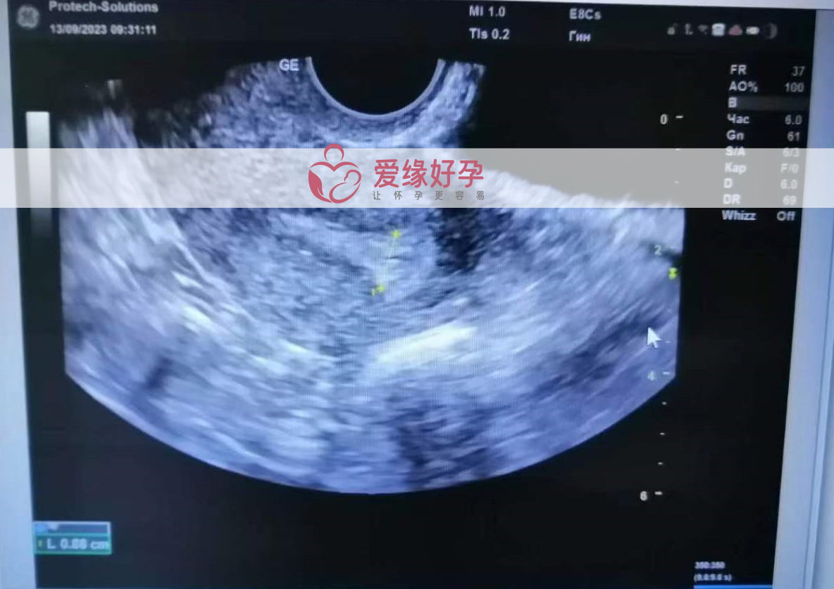 乌克兰哈萨克斯坦试管婴儿助孕孕妈移植一颗来自日本的囊胚！