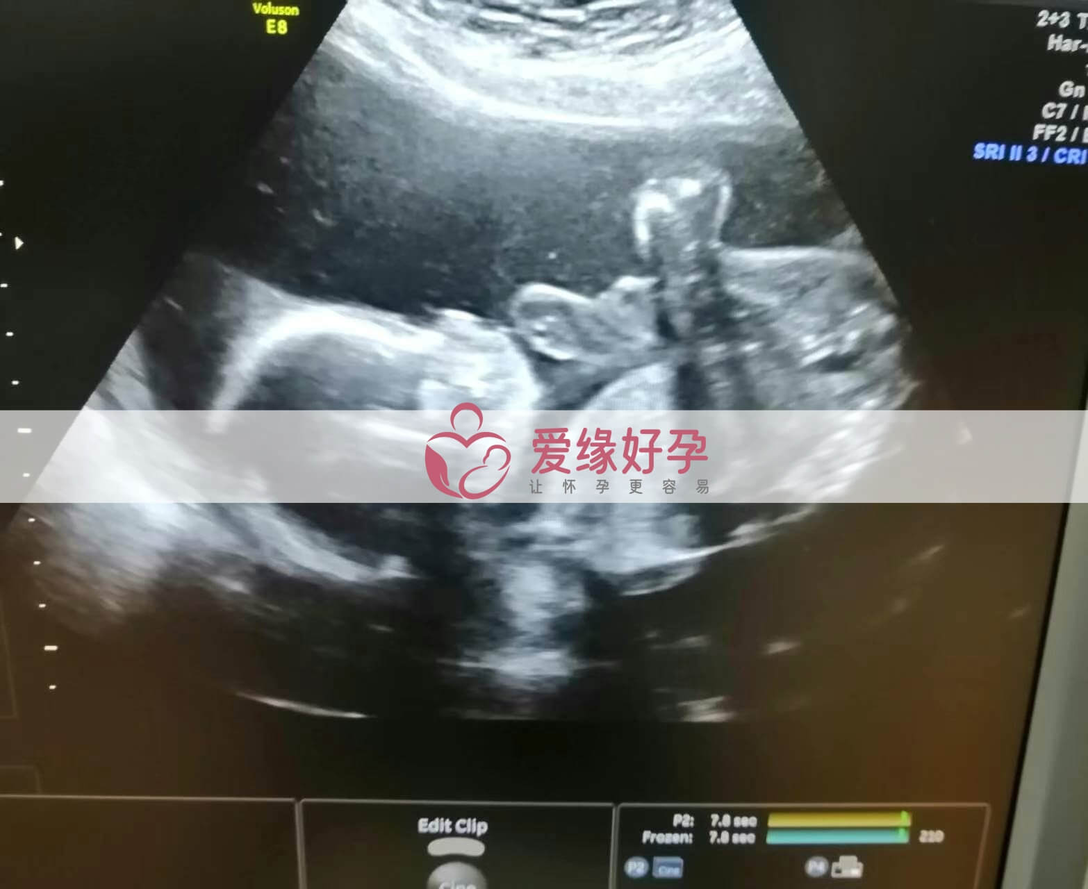 试管婴儿助孕爱心妈妈21周产检顺利通过