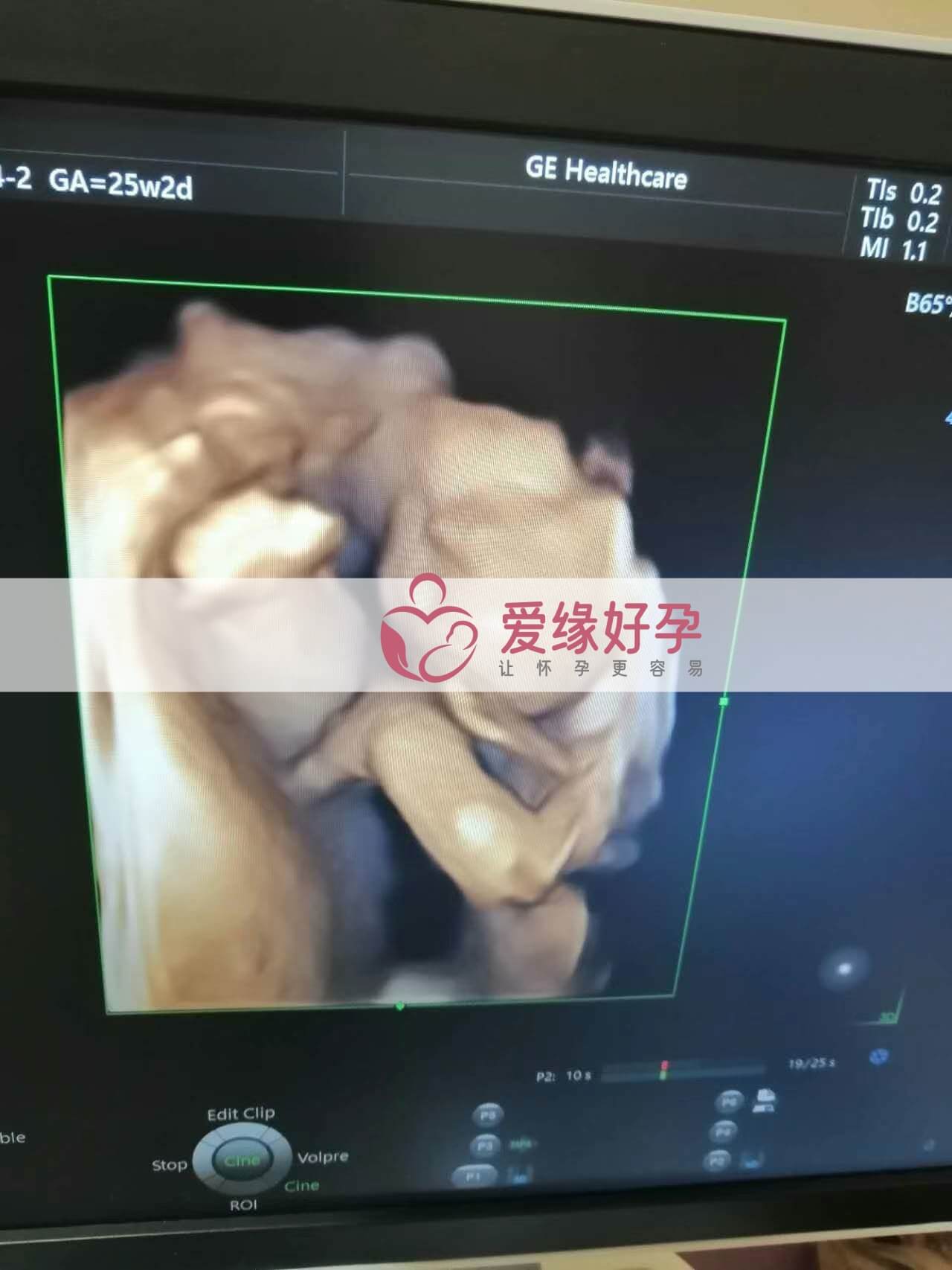 试管婴儿助孕爱心妈妈24周产检顺利通过