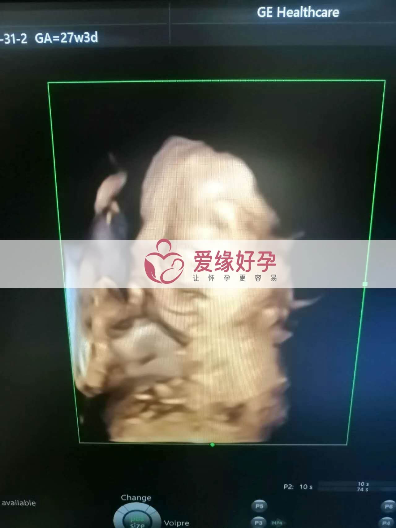 试管婴儿助孕爱心妈妈27周产检顺利通过