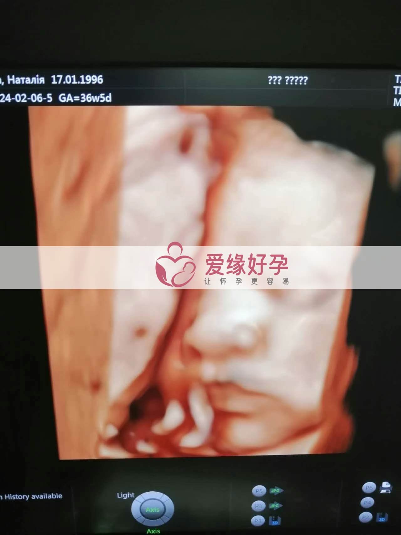 试管婴儿助孕爱心妈妈36周产检顺利通过