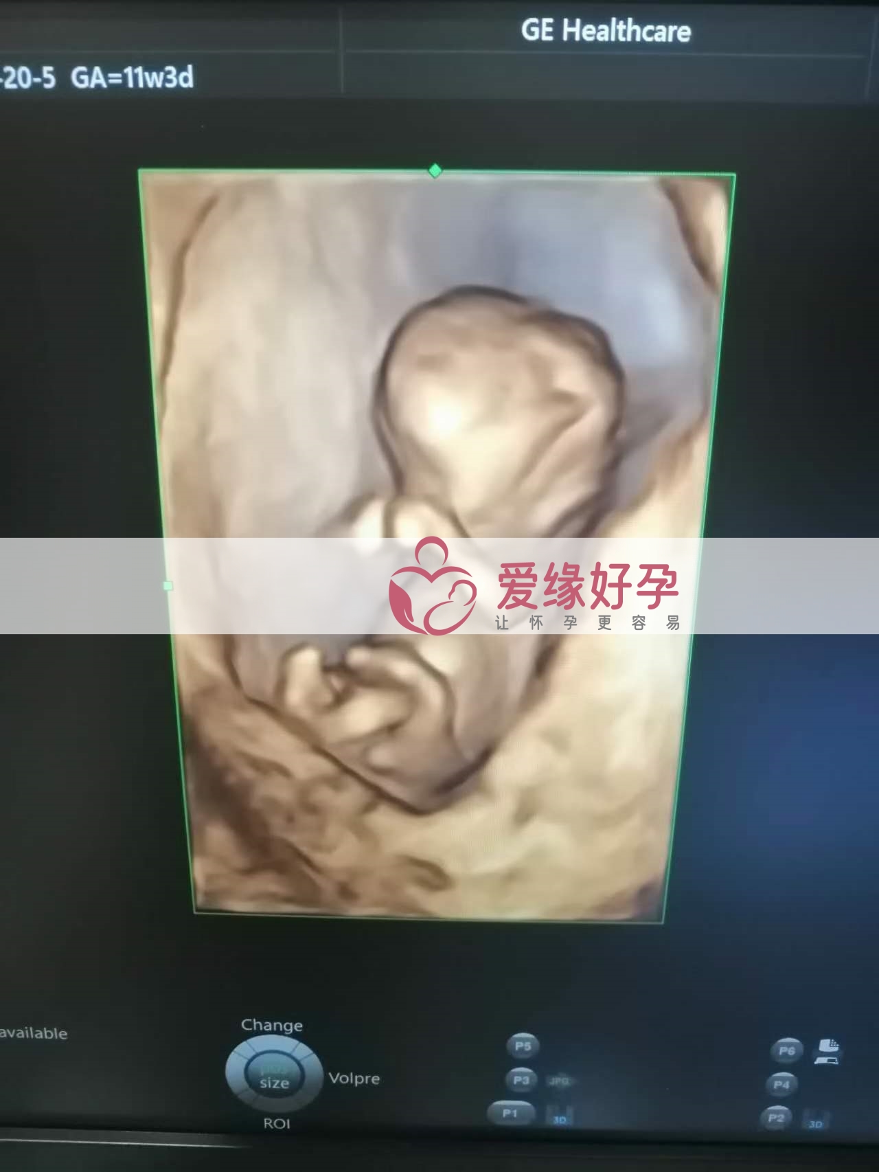 试管婴儿助孕爱心妈妈12周NT检查顺利通过