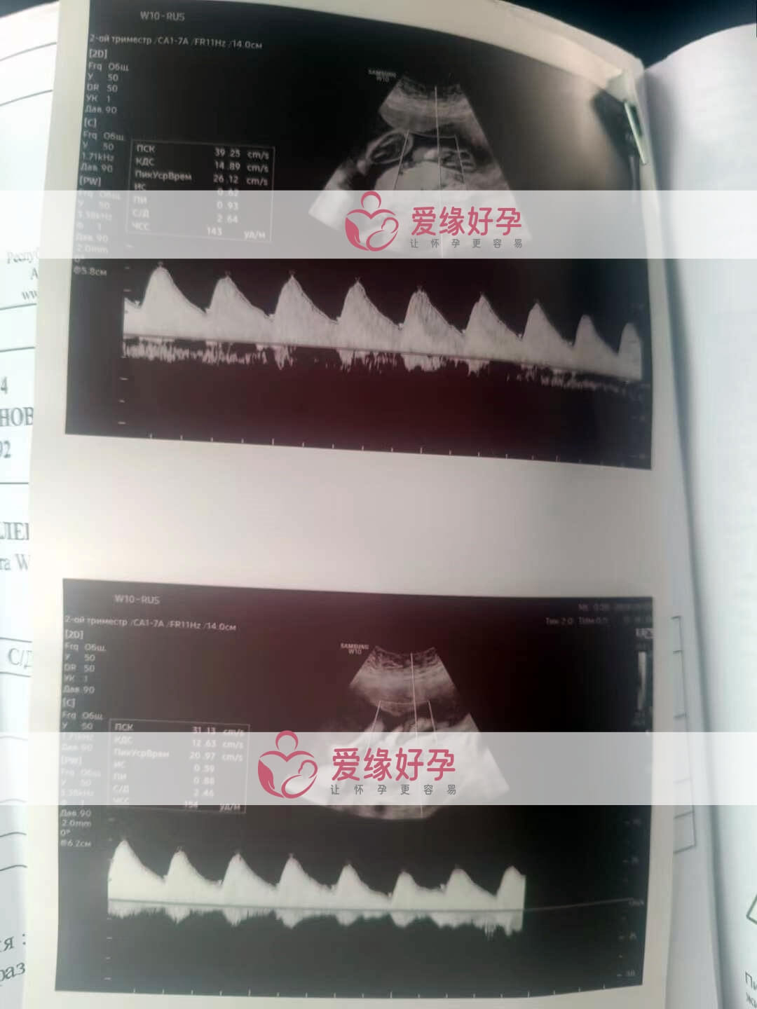 爱缘好孕:哈萨克斯坦爱心妈妈25周孕检顺利通过