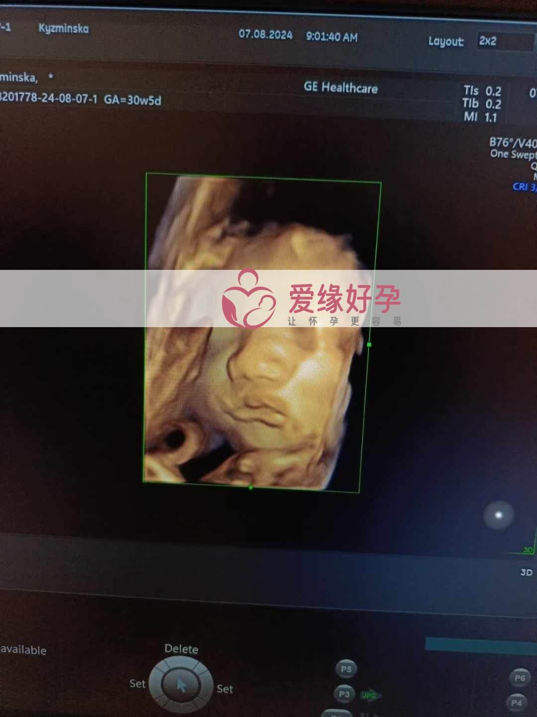 爱缘好孕乌克兰爱心志愿者30周孕检通过！