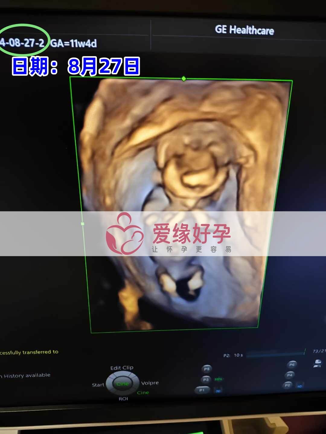 爱缘好孕乌克兰志愿者孕12周产检顺利通过！