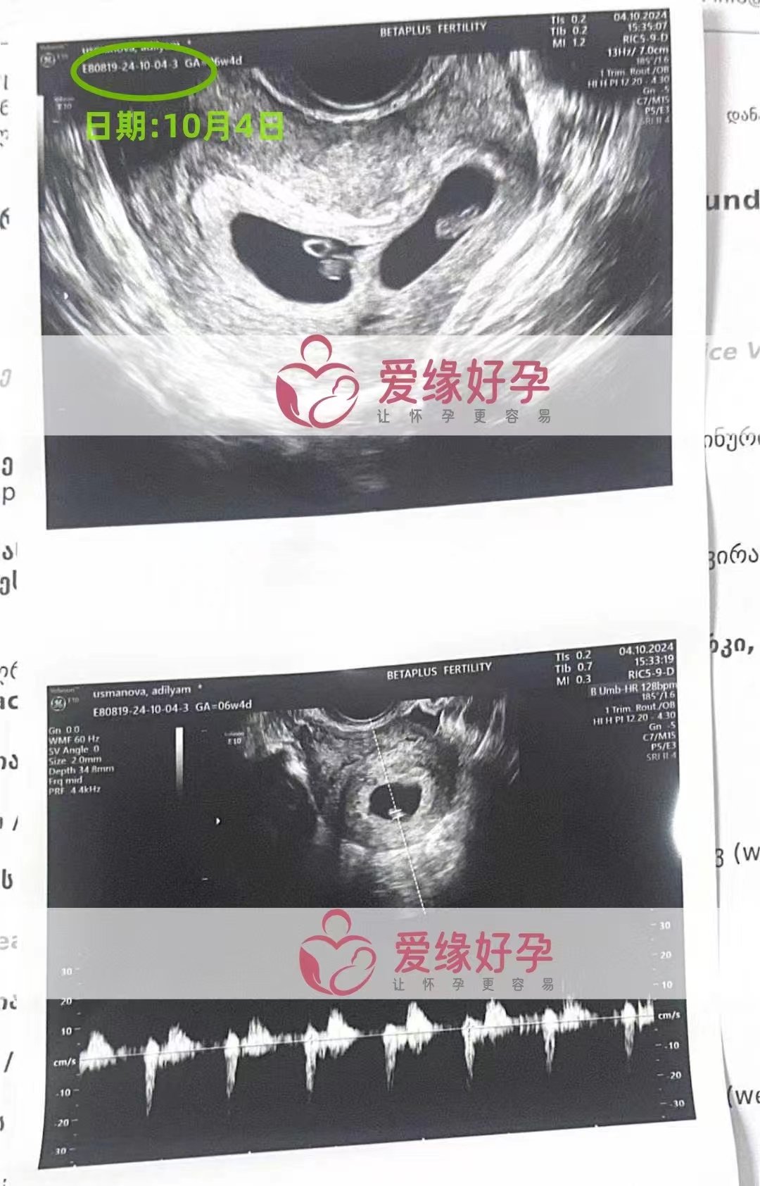 格鲁吉亚爱心使者的双胞胎孕6周产检顺利通过