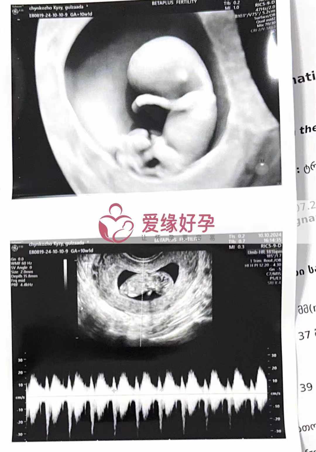 格鲁吉亚爱心使者孕10周产检顺利通过