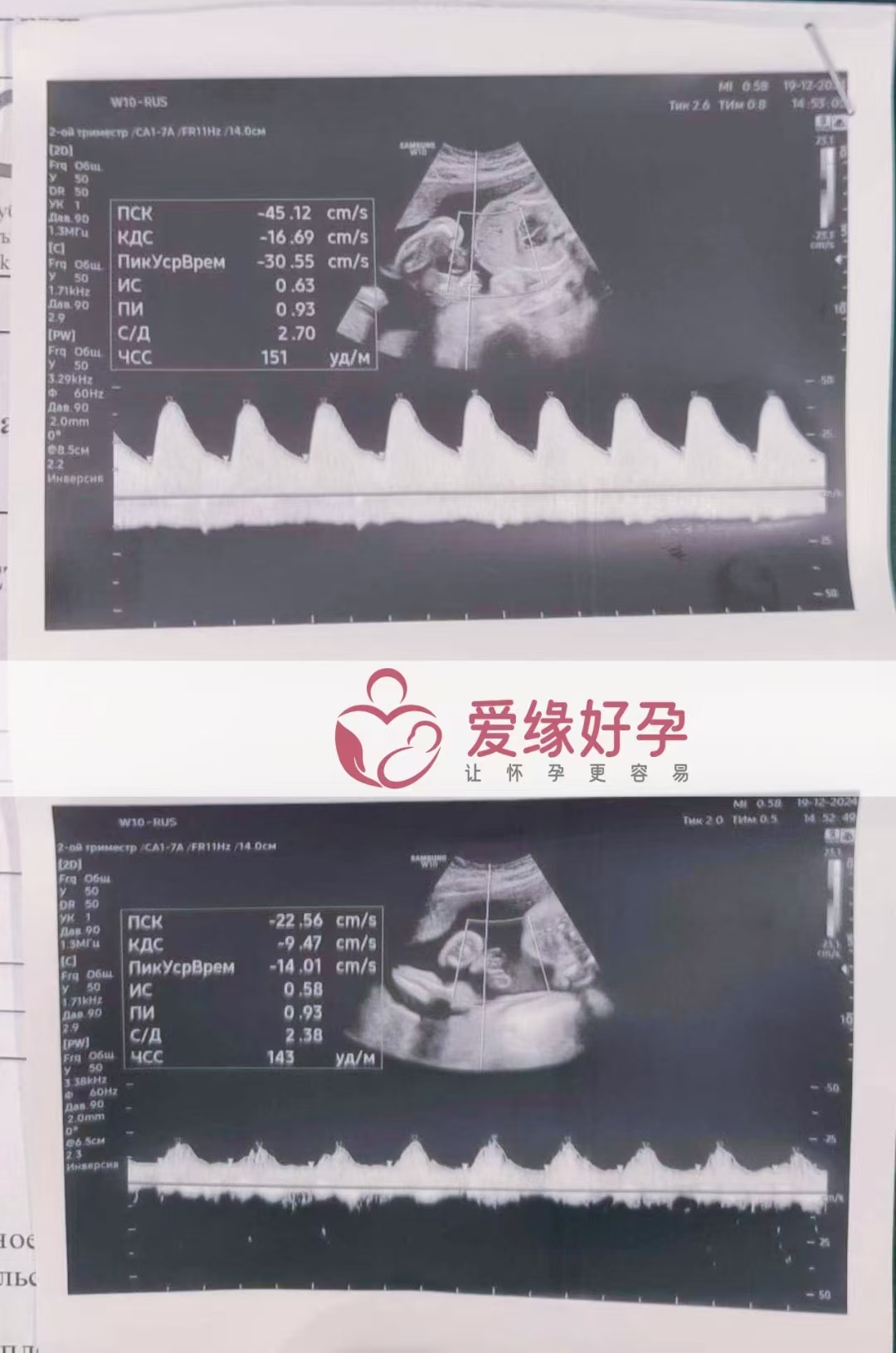 哈萨克斯坦爱心使者孕25周产检顺利通过