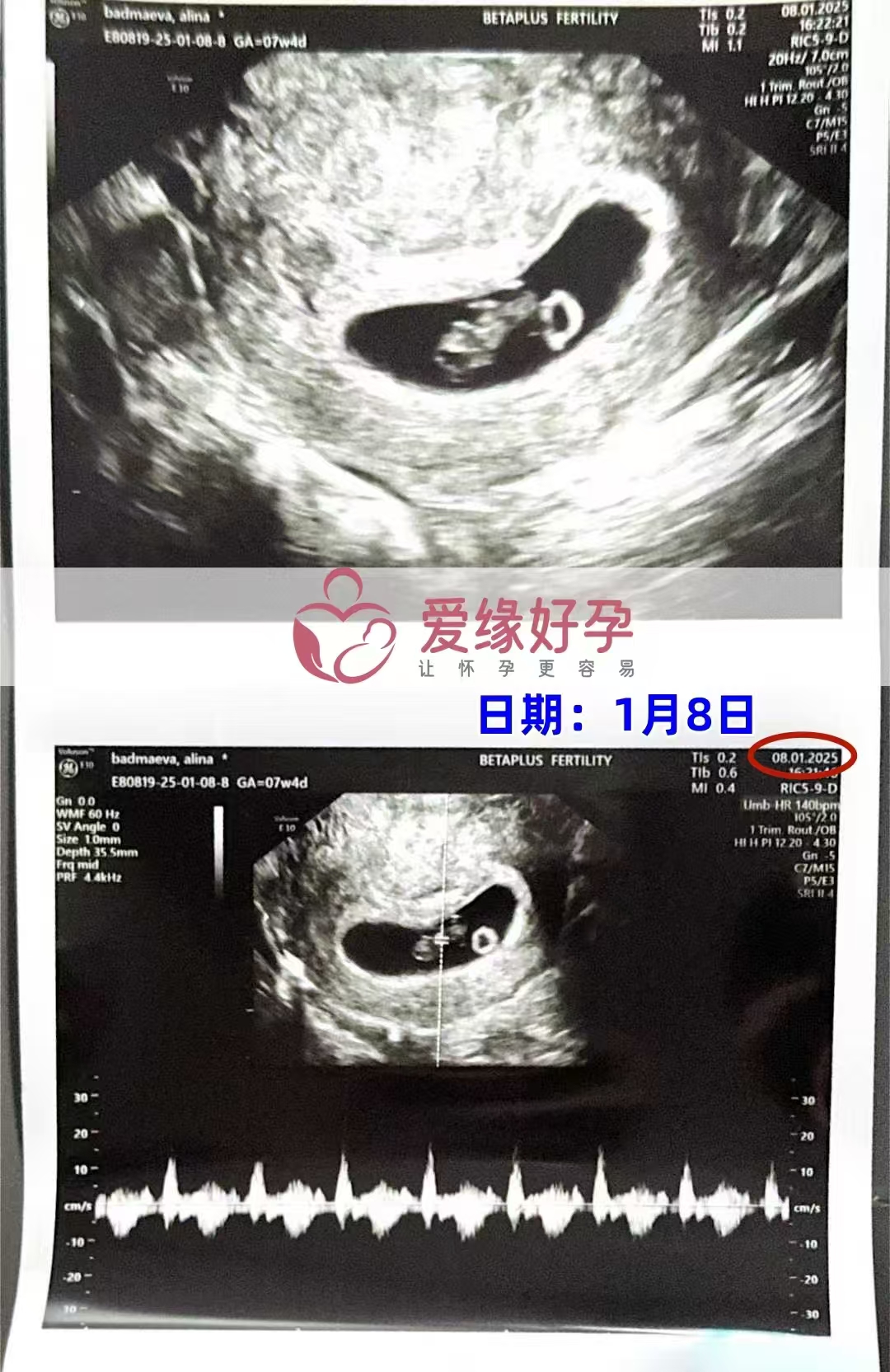 格鲁吉亚爱心使者孕7周产检顺利通过