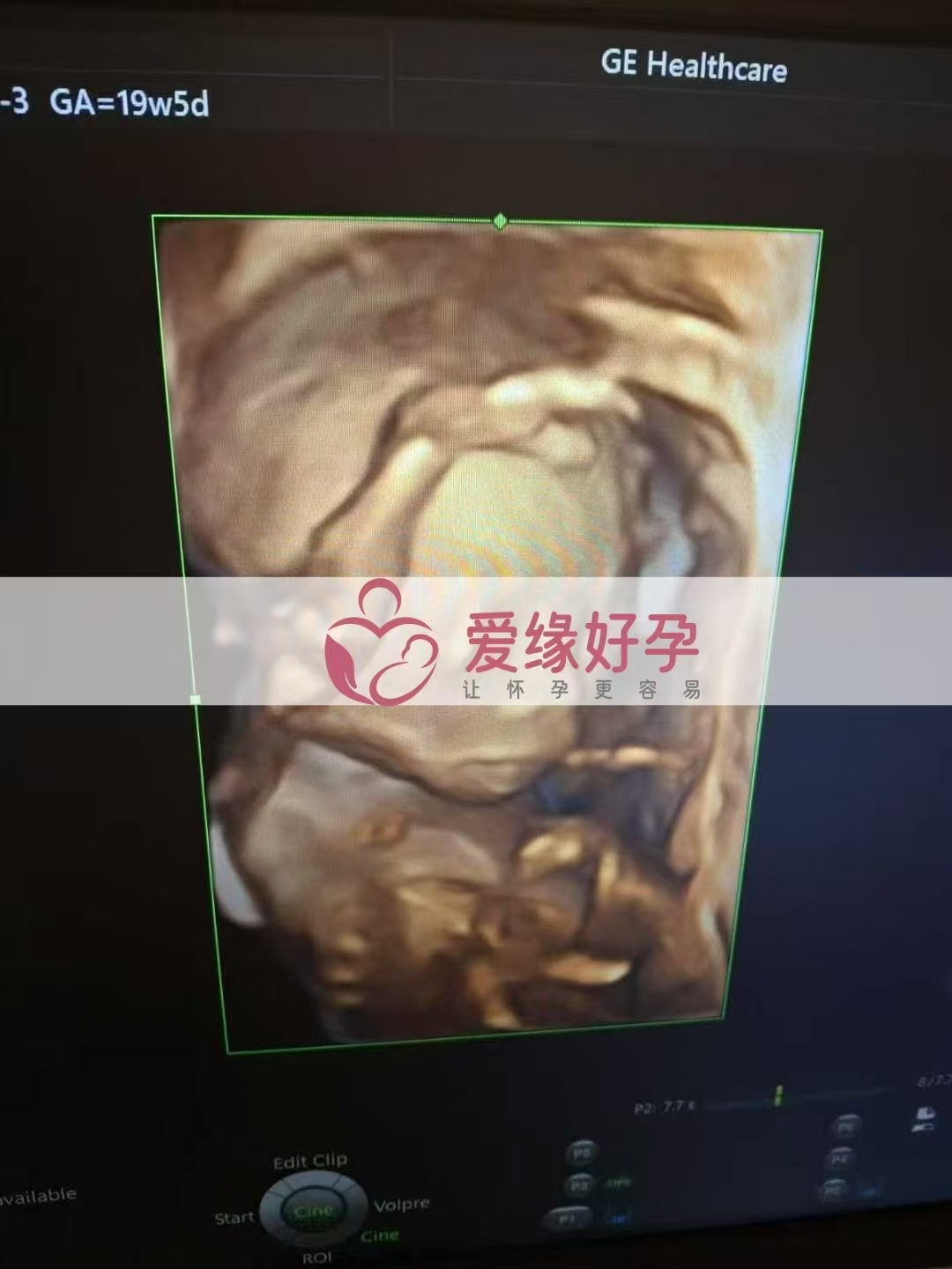 乌克兰爱心使者孕19周产检顺利通过