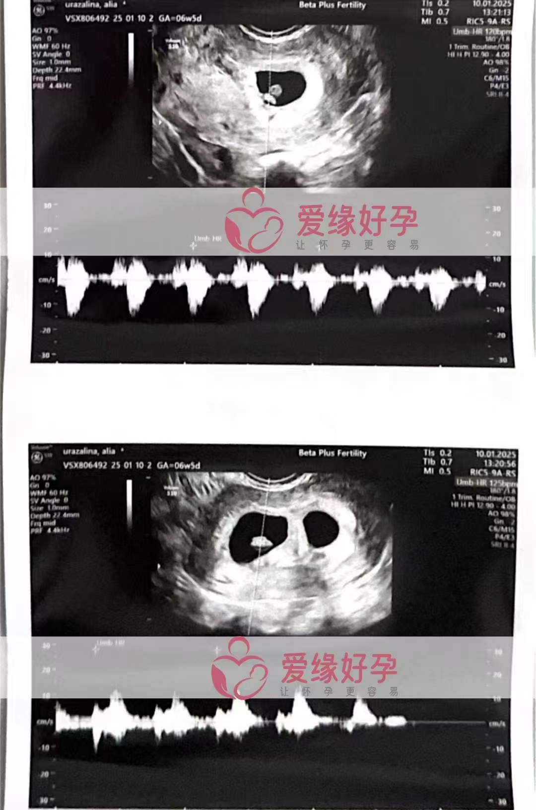格鲁吉亚爱心使者第一次B超验孕双胎成功