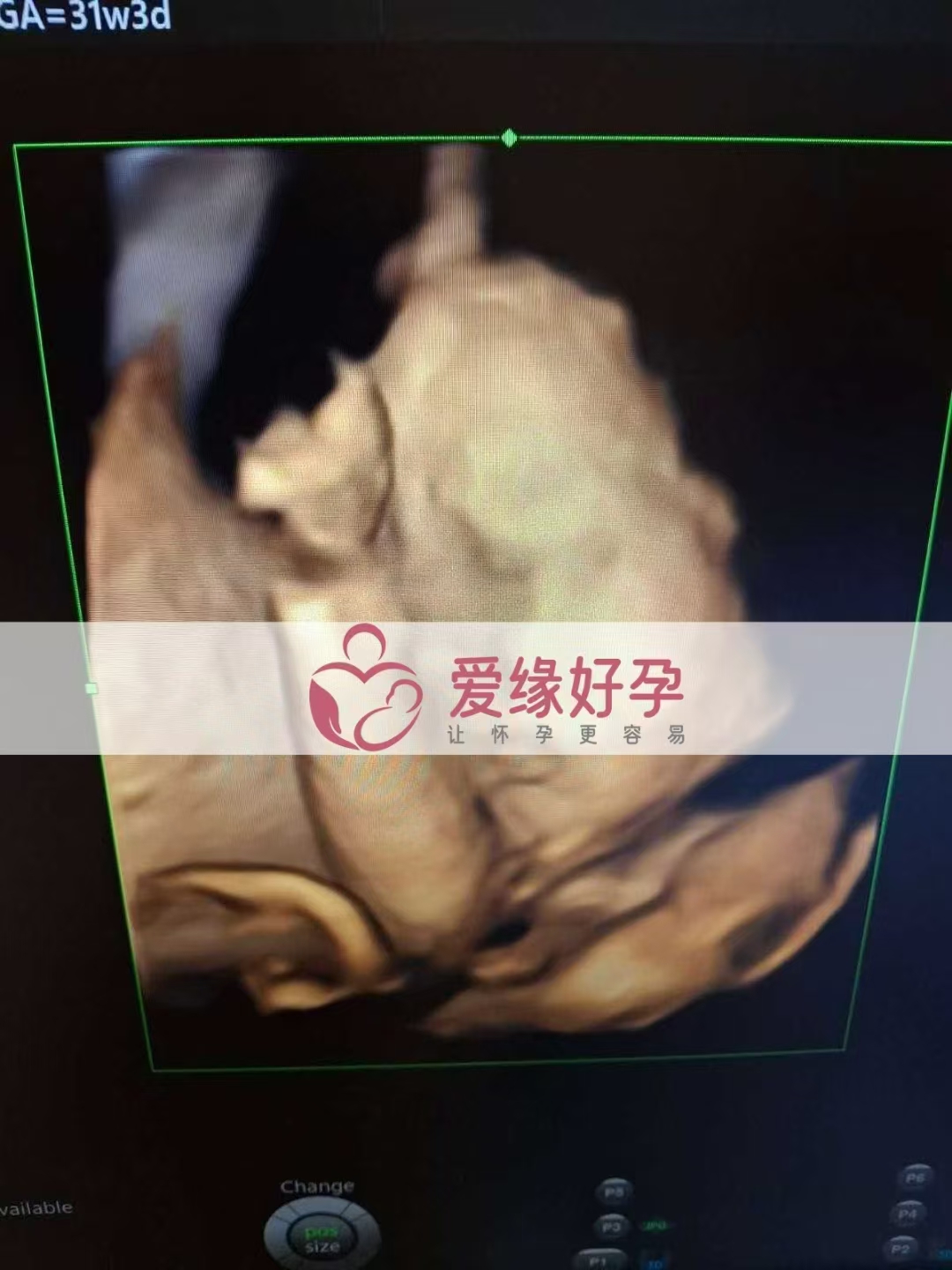 乌克兰爱心使者孕31周产检顺利通过