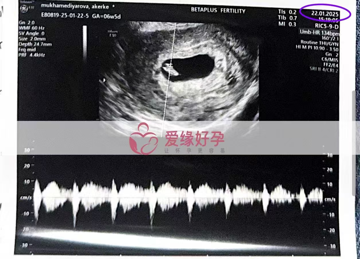 格鲁吉亚试管婴儿助孕爱心使者B超6周验孕验血成功