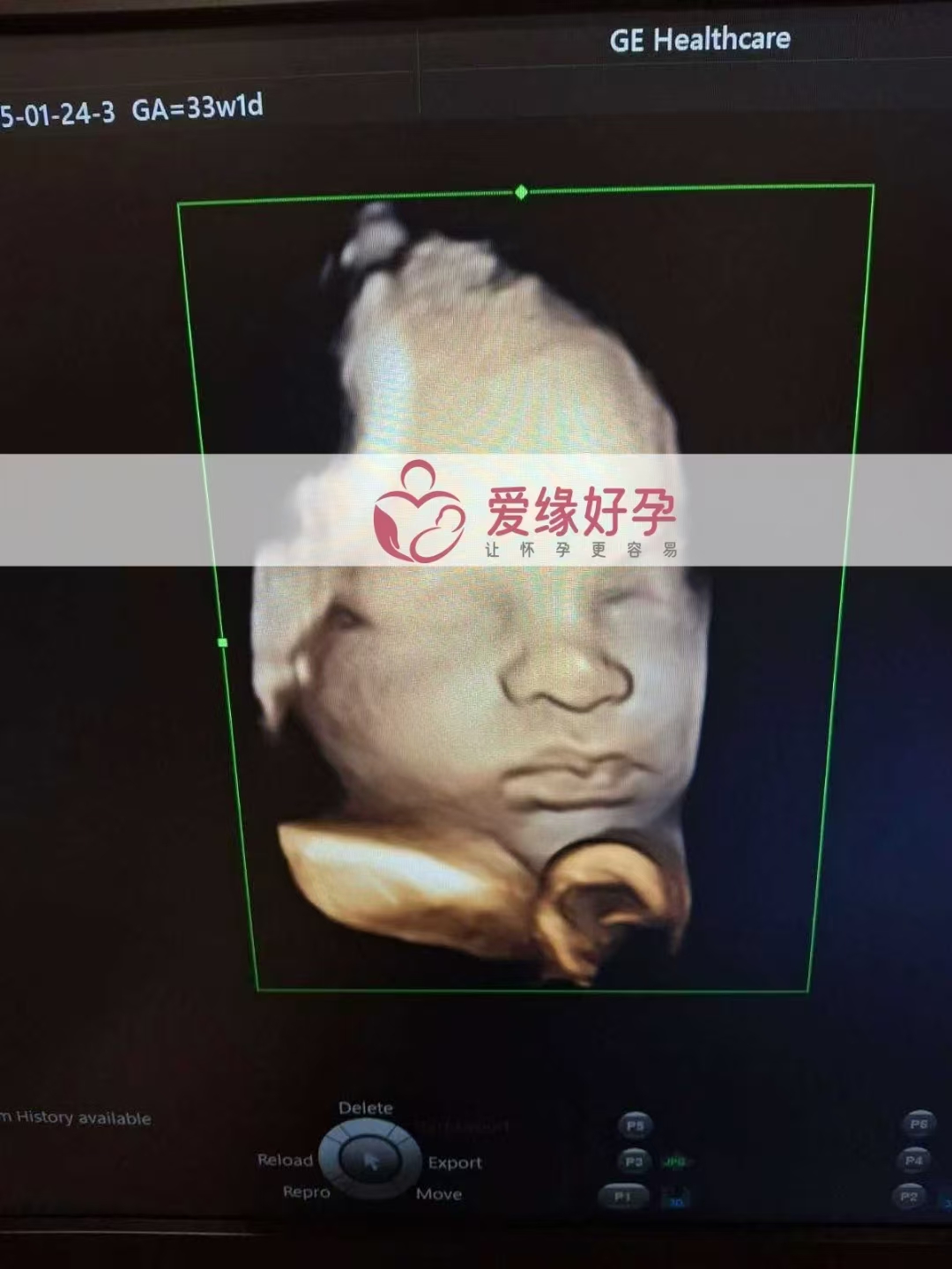 乌克兰试管婴儿助孕爱心使者33周产检顺利通过