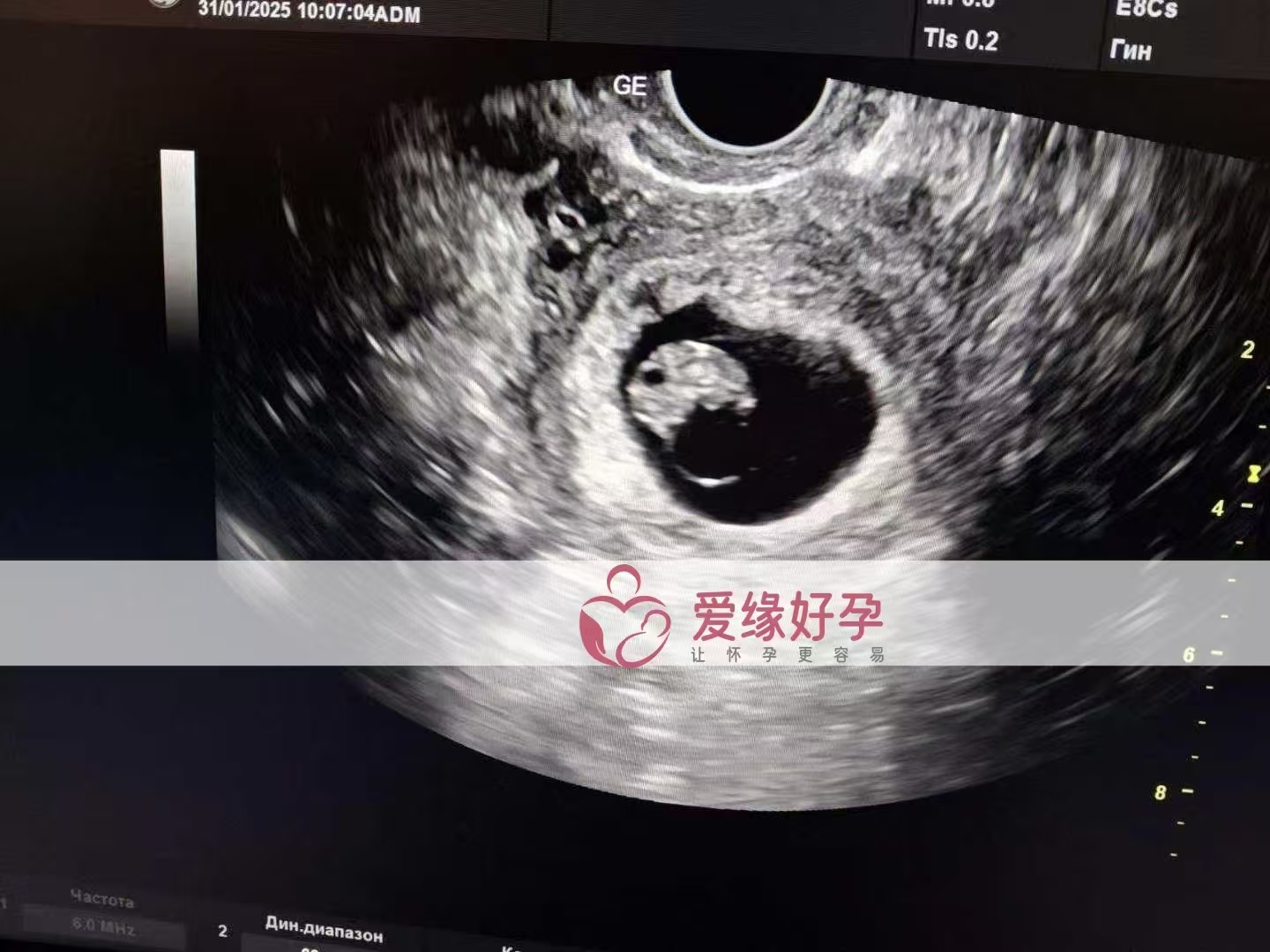 乌克兰试管婴儿助孕爱心使者8周产检顺利通过