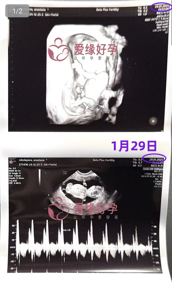 格鲁吉亚试管婴儿助孕爱心使者顺利渡过风险期