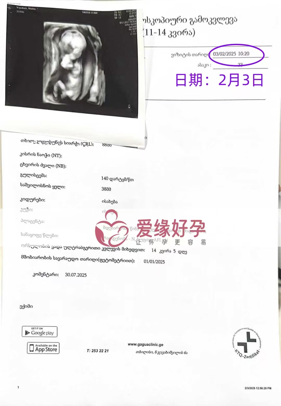 格鲁吉亚试管婴儿助孕爱心使者14周产检顺利通过