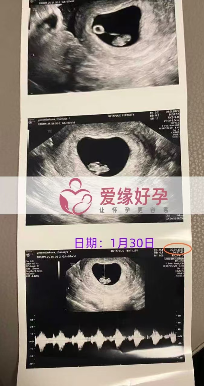 格鲁吉亚试管婴儿助孕爱心使者，新生命迈出第一步