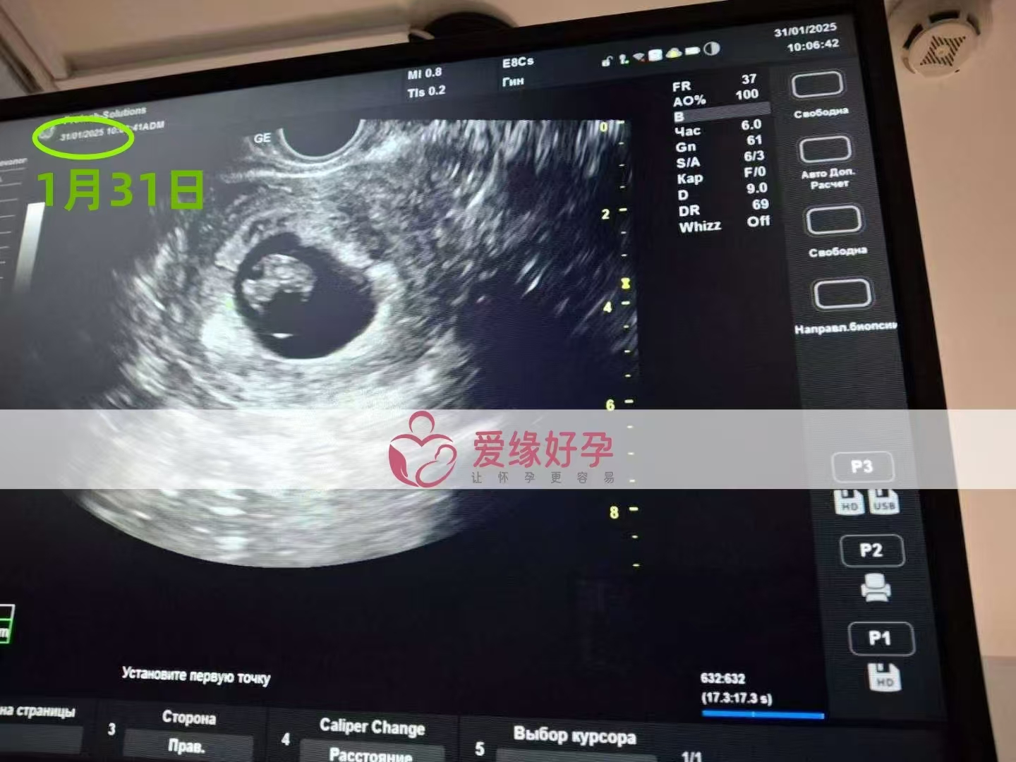 乌克兰试管婴儿助孕爱心使者8周产检顺利通过