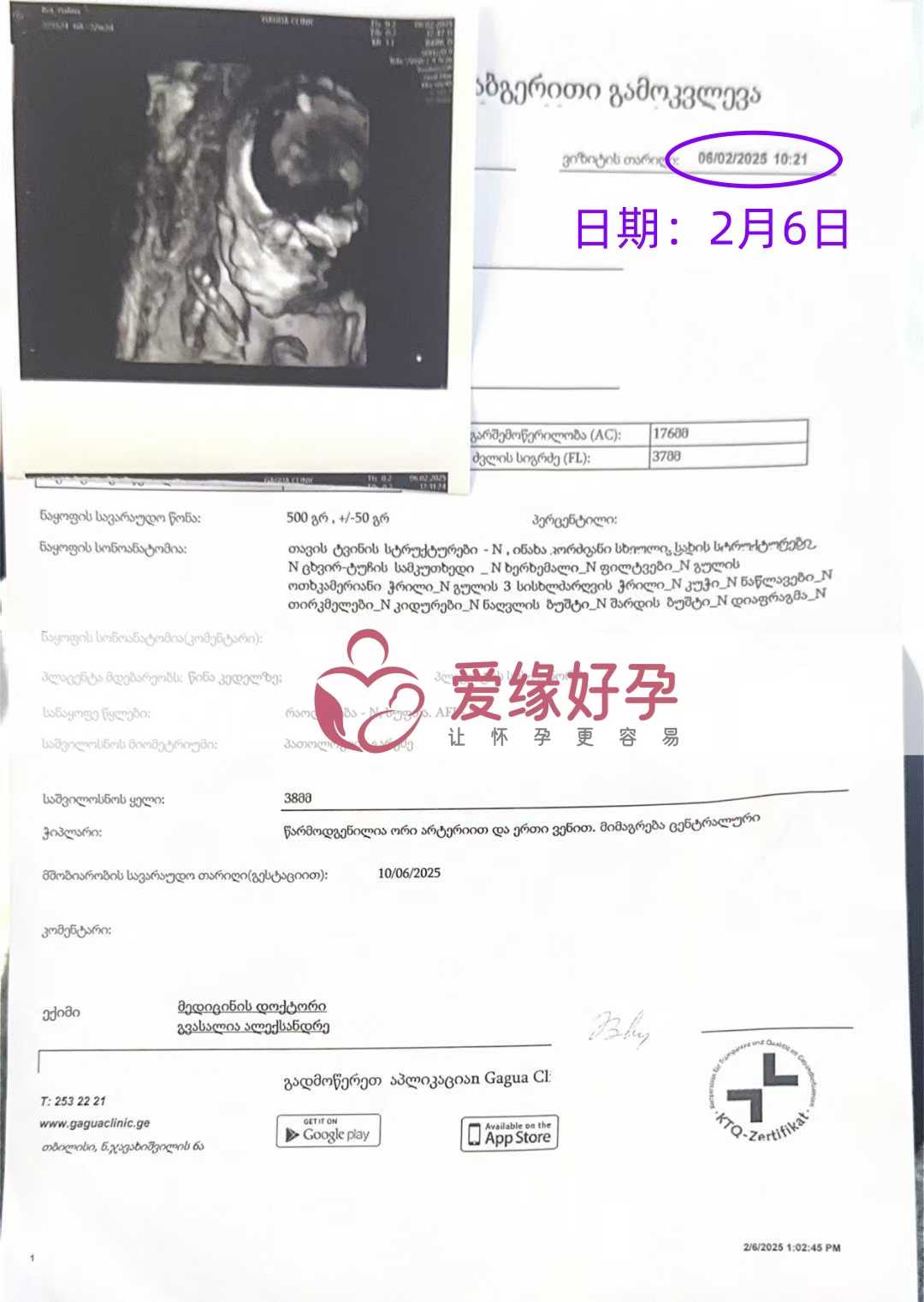 格鲁吉亚试管婴儿助孕爱心使者22周产检进展良好