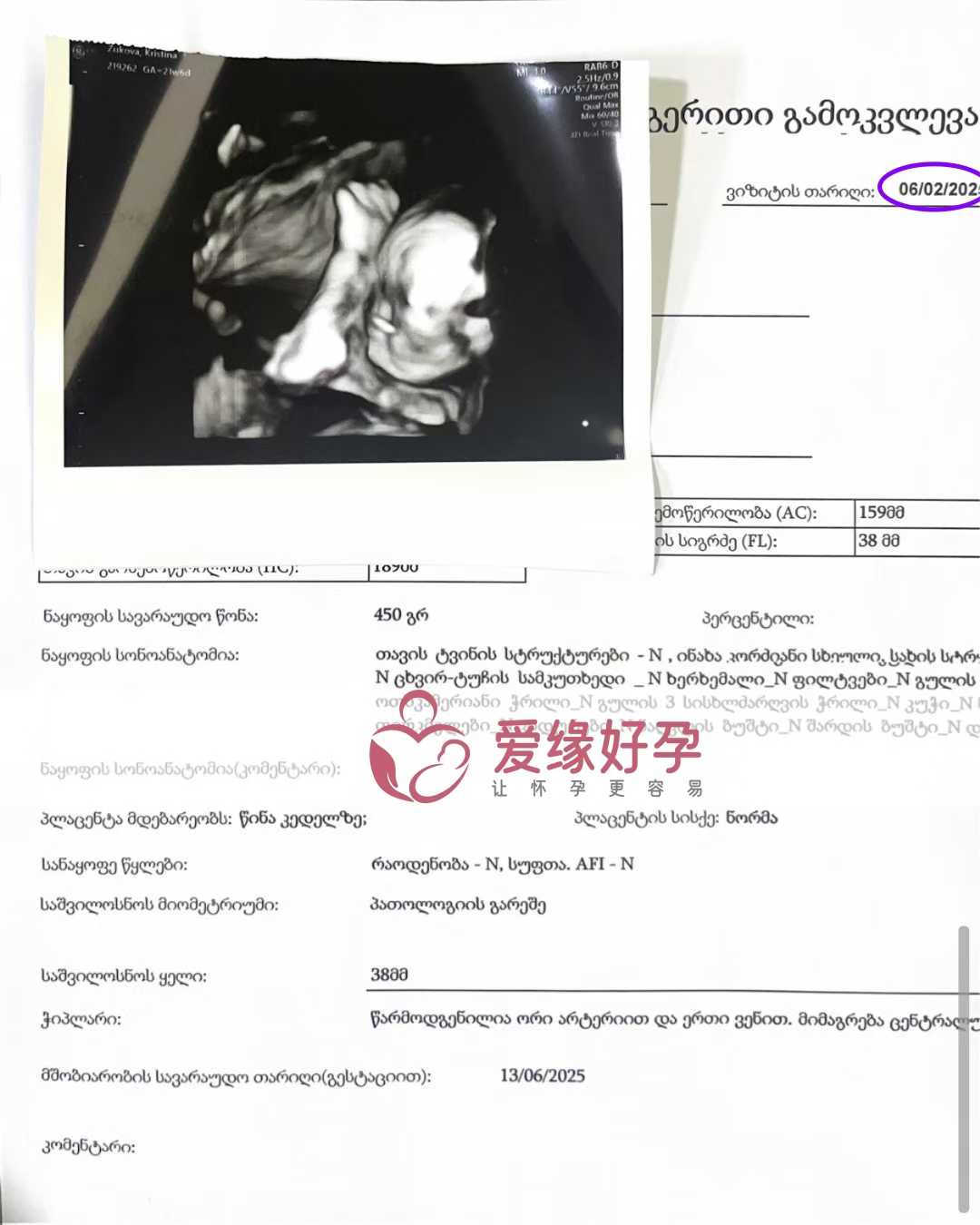 格鲁吉亚试管婴儿助孕爱心使者21周产检进展顺利