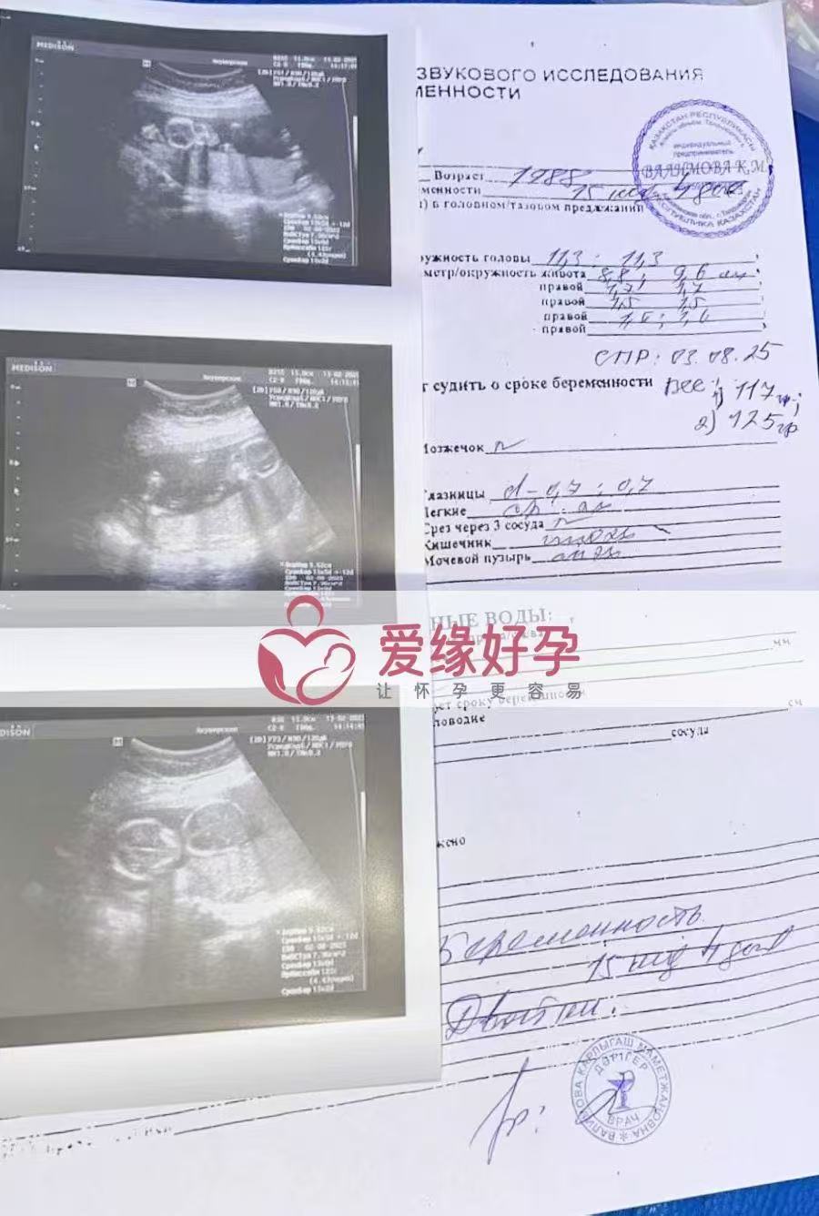 格鲁吉亚试管婴儿助孕爱心使者顺利步入稳定期