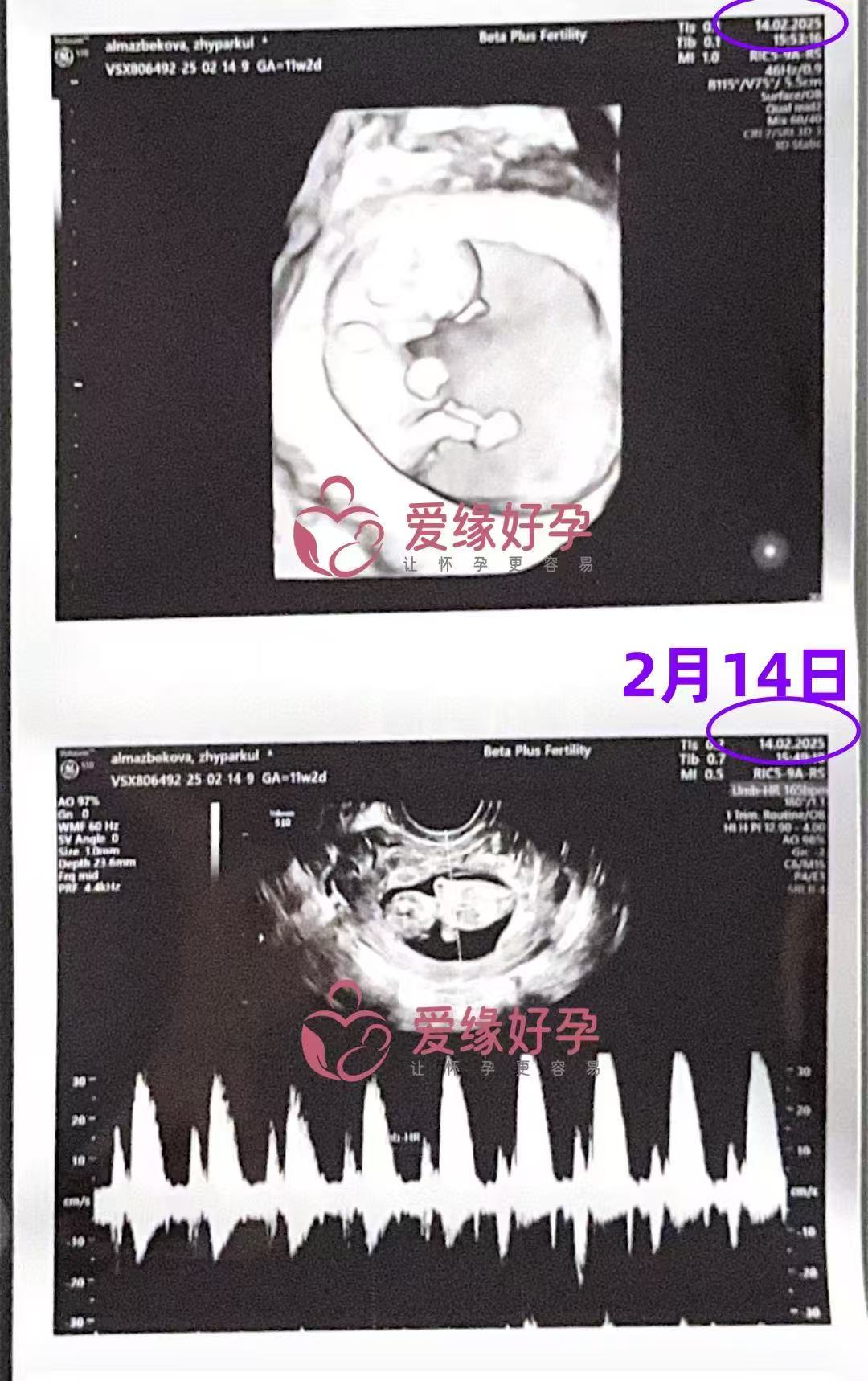 格鲁吉亚试管婴儿助孕爱心使者11周产检顺利通过