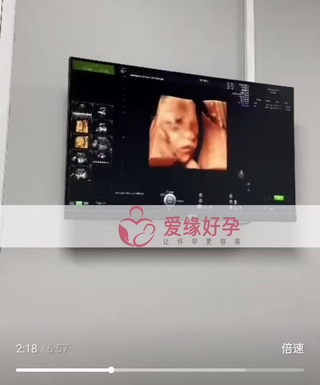 格鲁吉亚试管婴儿助孕爱心使者成功度过风险期