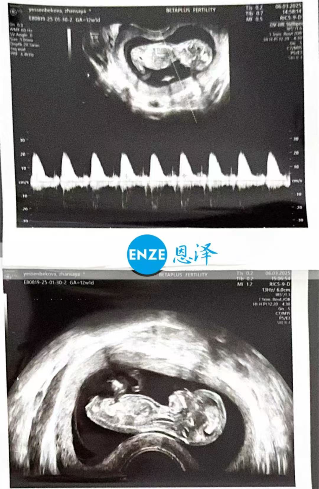 格鲁吉亚试管婴儿助孕爱心使者12周产检顺利，正式进入稳定期