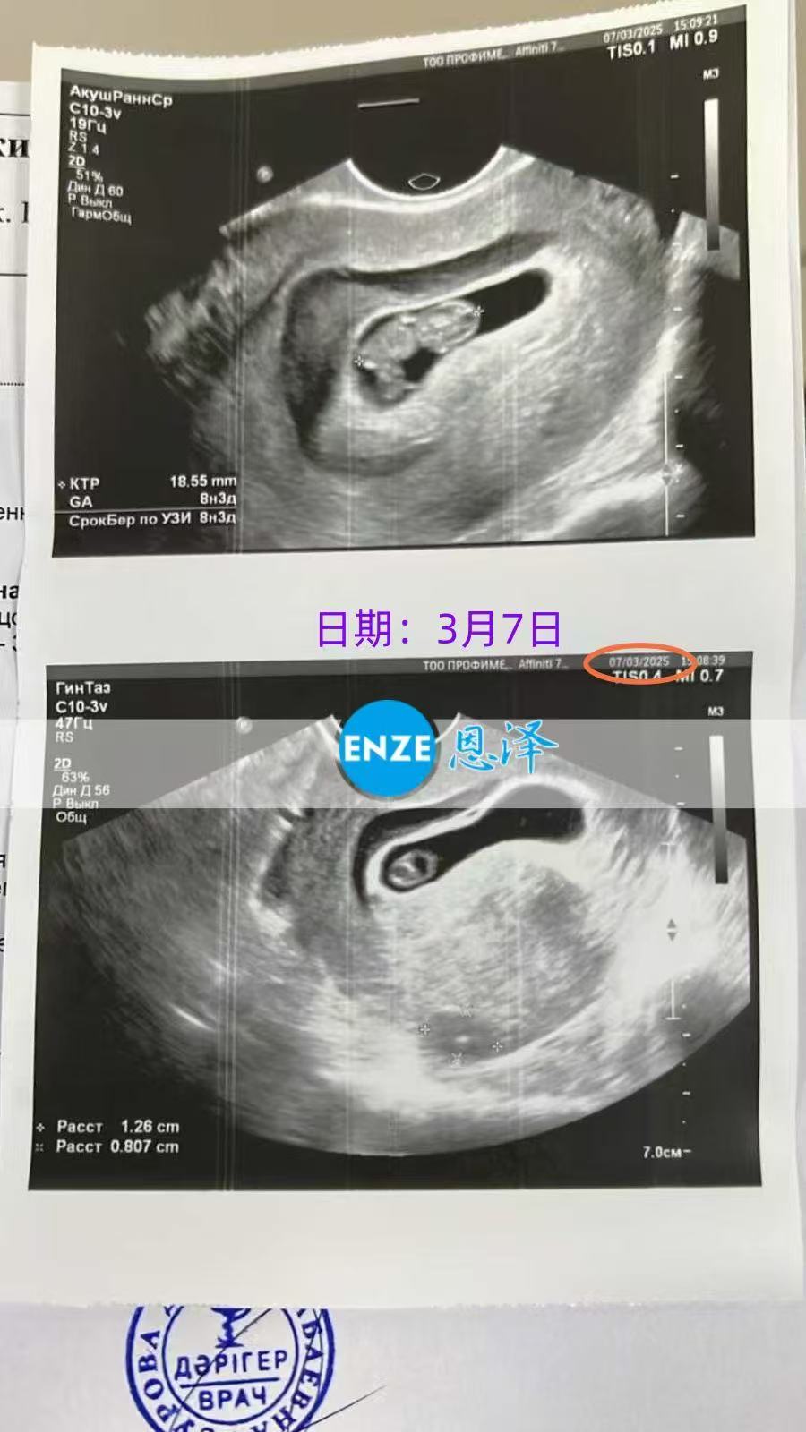 格鲁吉亚试管婴儿助孕爱心使者8周产检进展顺利