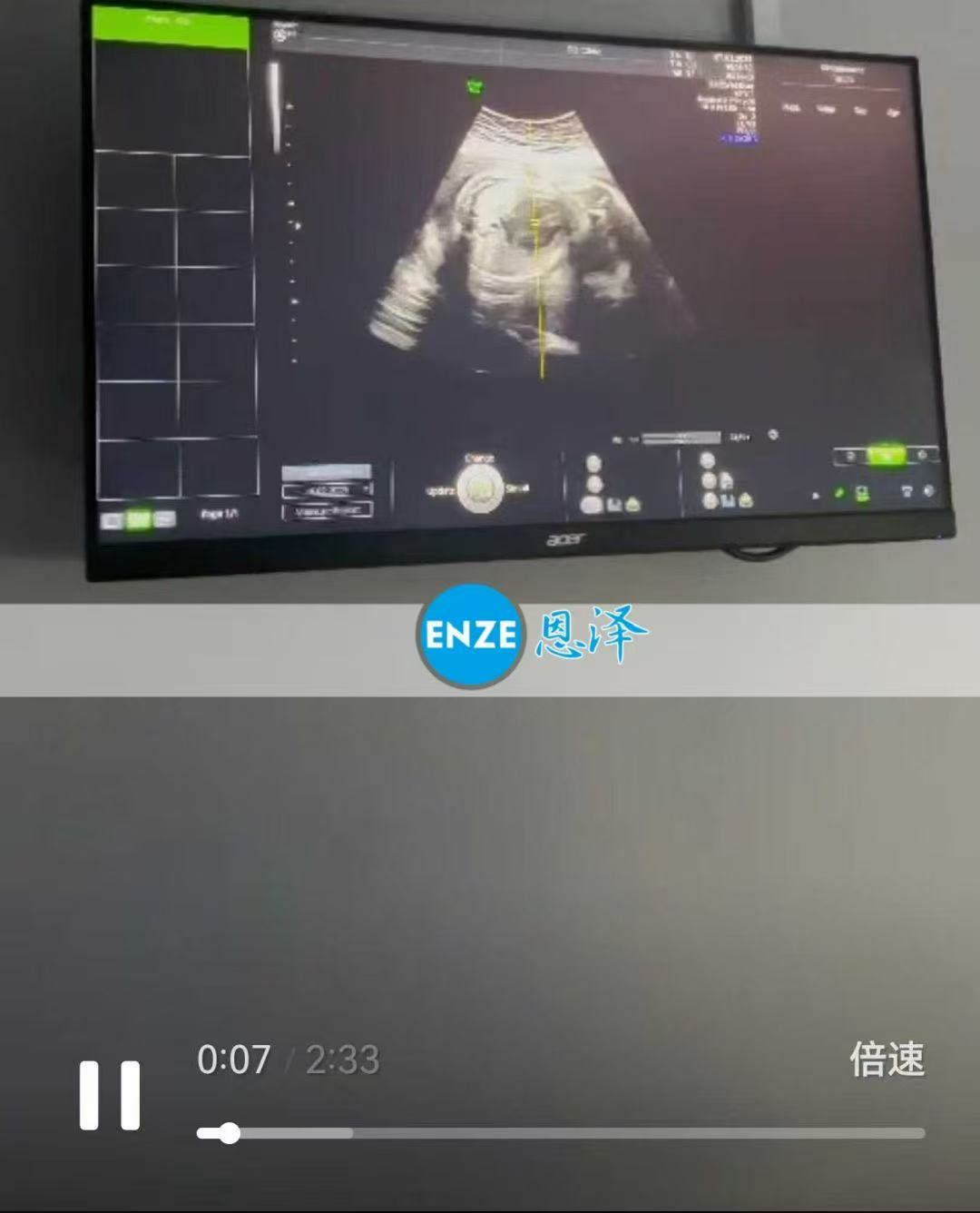 格鲁吉亚试管婴儿助孕爱心使者29周产检进展顺利