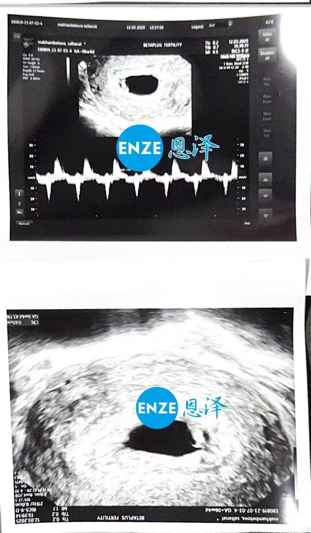 格鲁吉亚试管婴儿助孕爱心使者8周第一次产检顺利通过