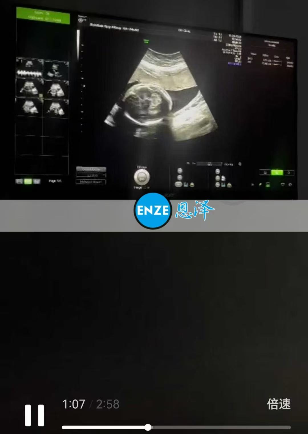 格鲁吉亚试管婴儿助孕爱心使者24周产检顺利通过